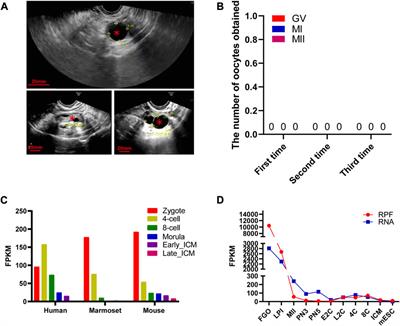 Case report: A novel homozygous variant in ZP3 is associated with human empty follicle syndrome